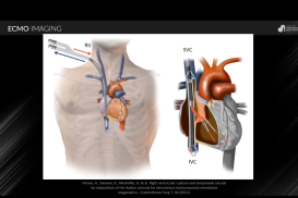 SCA Clinical Update:  Imaging for Mechanical Circulatory Support Devices—ECMO and Beyond